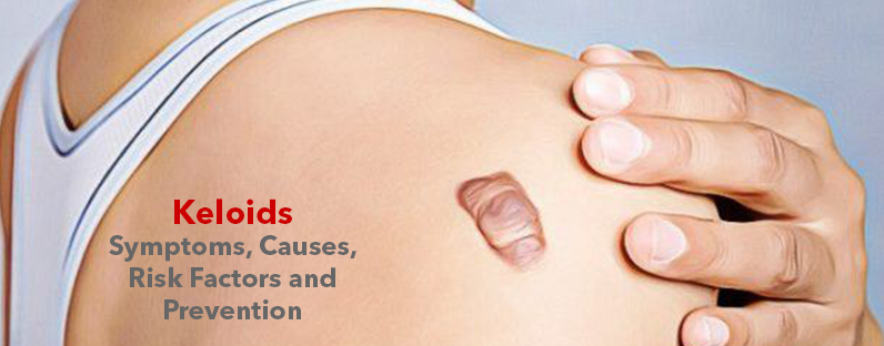 Keloids- Symptoms, Causes, Risk Factors and Prevention