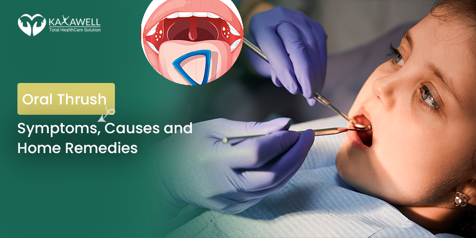 Oral Thrush- Symptoms, Causes and Home Remedies