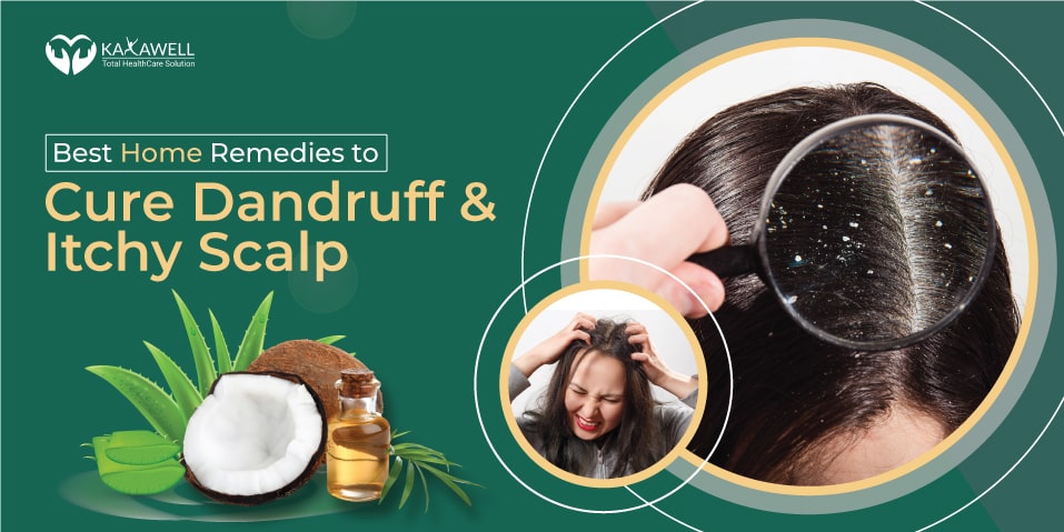 Home Remedies to cure dandruff and itchy scalp
