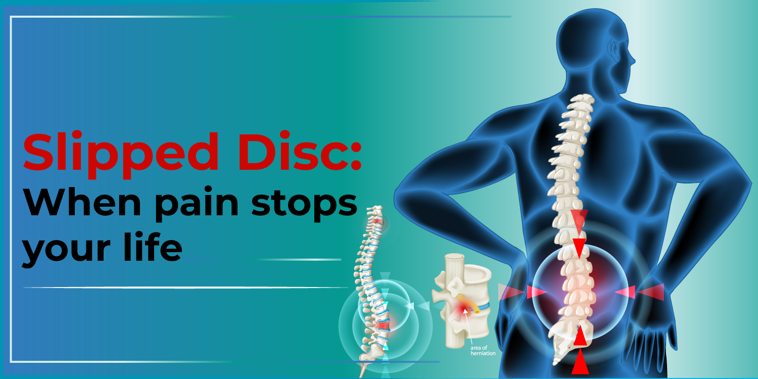 herniated disk, slipped disc